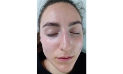 Isabelle SPA. Ce sunt mezoterapiile featured image